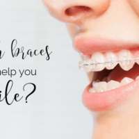 Which braces will help you smile?