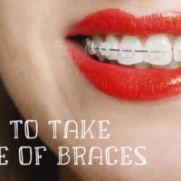 How to take care of braces